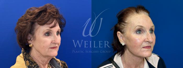 Before & After Facelift Case 1780 Right Oblique View in Baton Rouge, New Orleans, & Lafayette, Louisiana