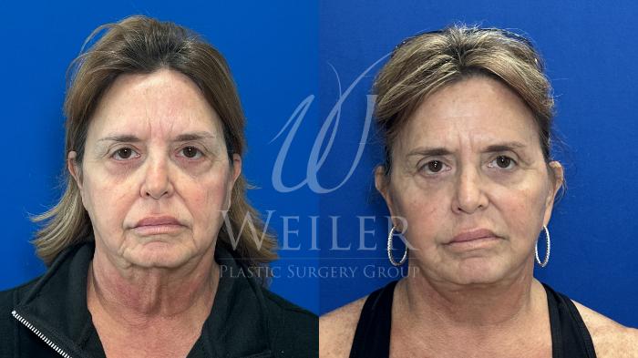 Before & After Facelift Case 1784 Front View in Baton Rouge, New Orleans, & Lafayette, Louisiana