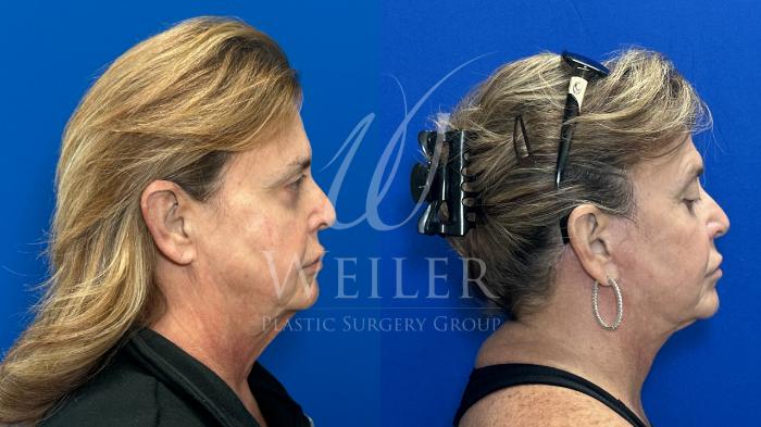 Before & After Facelift Case 1784 Right Side View in Baton Rouge, New Orleans, & Lafayette, Louisiana