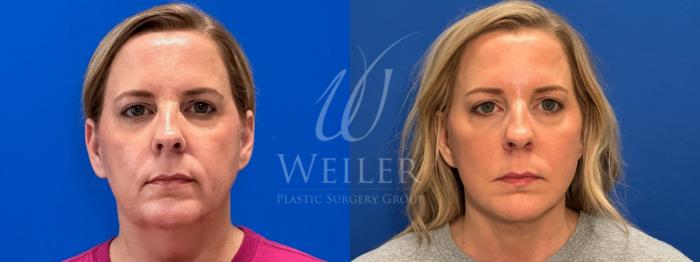 Before & After Facelift Case 1787 Front View in Baton Rouge, New Orleans, & Lafayette, Louisiana