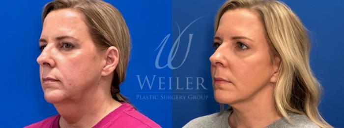 Before & After Facelift Case 1787 Left Oblique View in Baton Rouge, New Orleans, & Lafayette, Louisiana