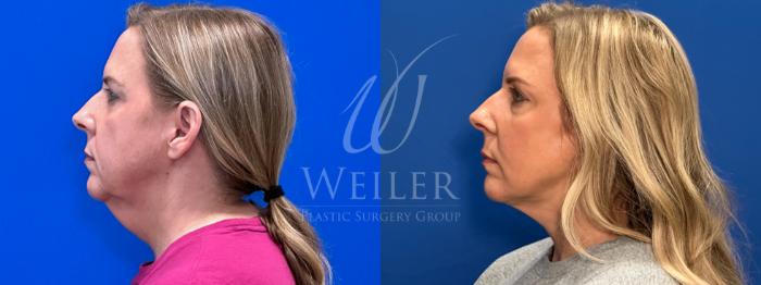 Before & After Facelift Case 1787 Left Side View in Baton Rouge, New Orleans, & Lafayette, Louisiana