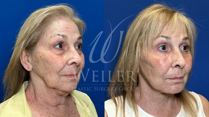 Before & After Facelift Case 1806 Right Oblique View in Baton Rouge, New Orleans, & Lafayette, Louisiana