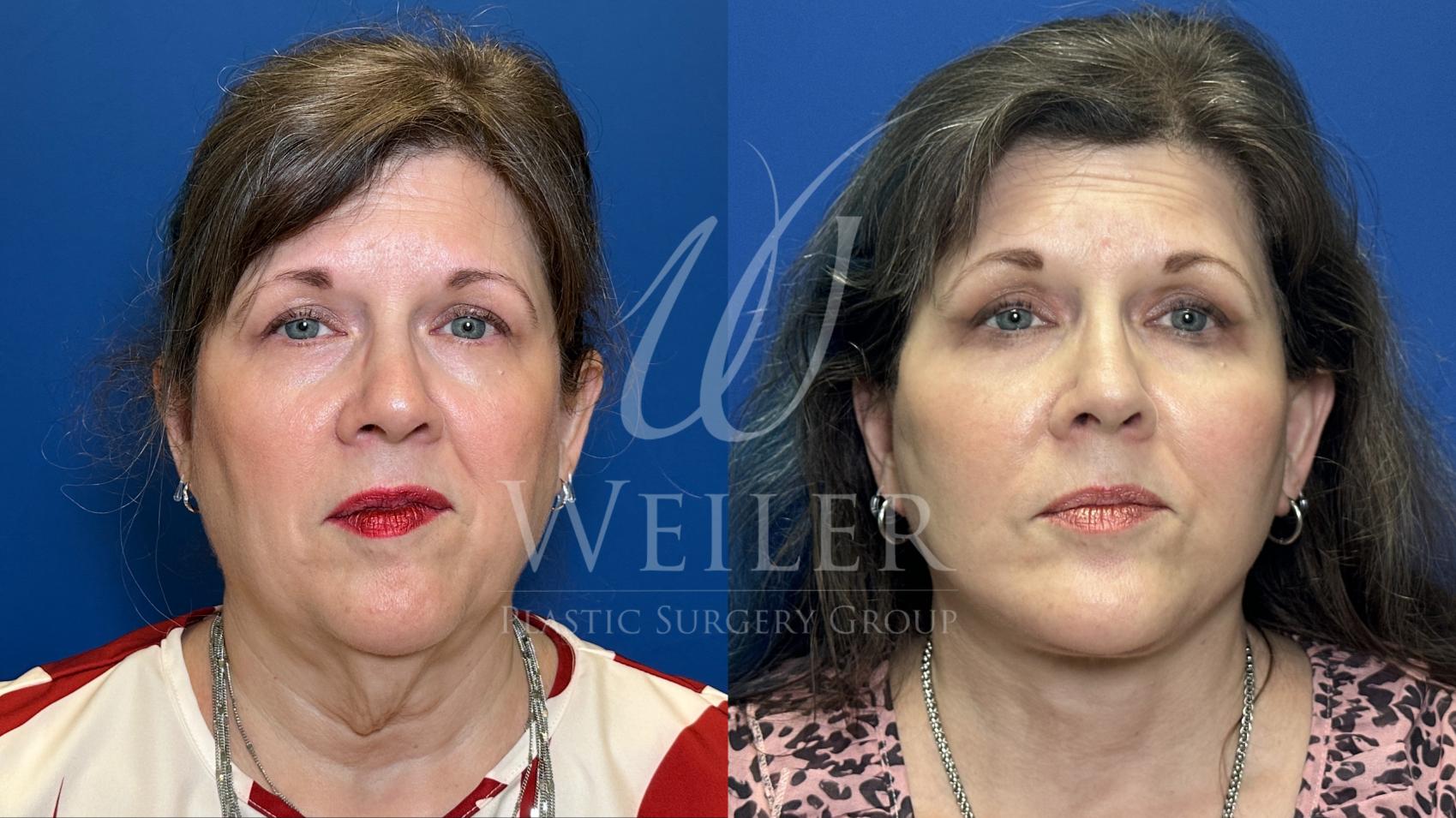 Before & After Facelift Case 1813 Front View in Baton Rouge, New Orleans, & Lafayette, Louisiana