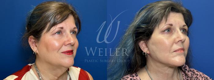 Before & After Facelift Case 1813 Right Oblique View in Baton Rouge, New Orleans, & Lafayette, Louisiana