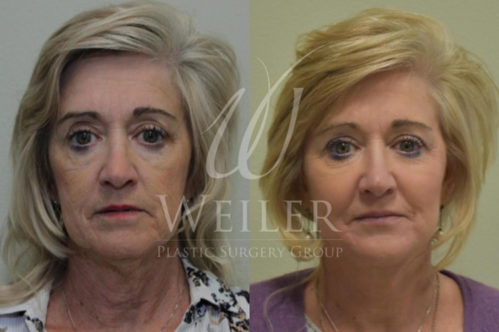 Before & After Facelift Case 271 View #1 View in Baton Rouge, Louisiana