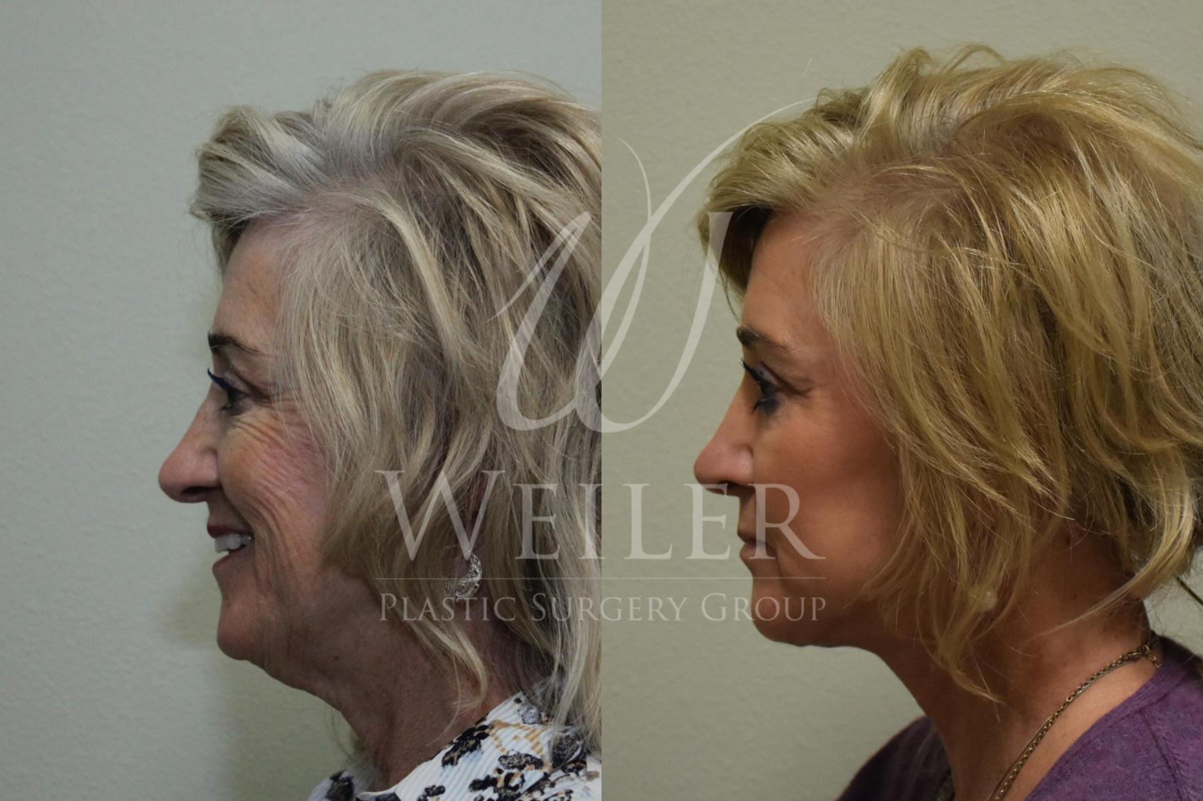Before & After Facelift Case 271 View #2 View in Baton Rouge, Louisiana