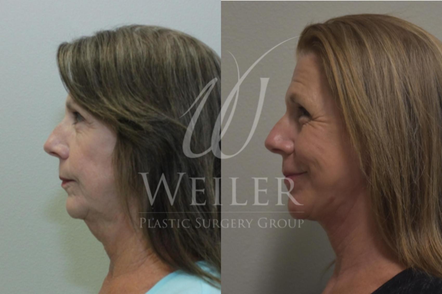 Before & After Facelift Case 277 View #1 View in Baton Rouge, Louisiana