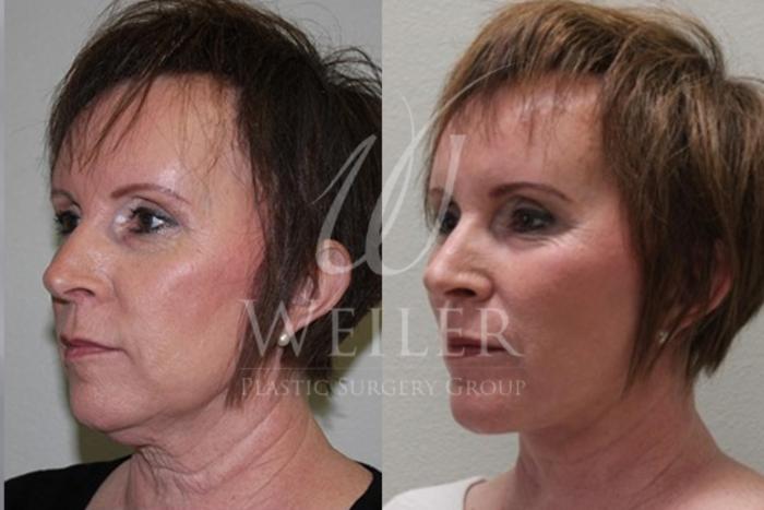 Before & After Facelift Case 28 View #1 View in Baton Rouge, New Orleans, & Lafayette, Louisiana