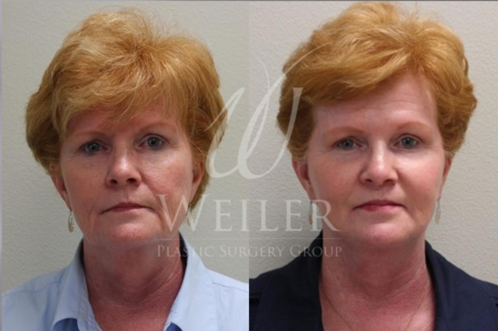 Before & After Facelift Case 29 View #1 View in Baton Rouge, Louisiana