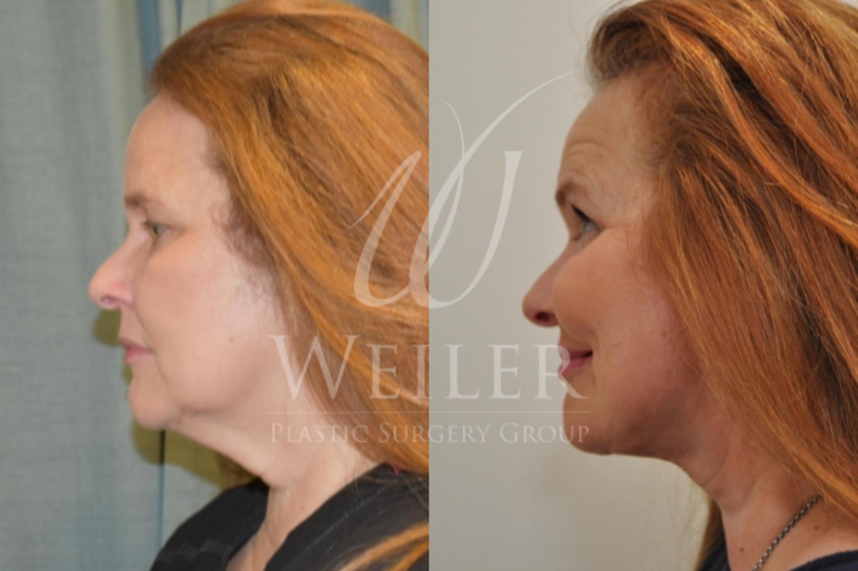 Before & After Facelift Case 296 View #1 View in Baton Rouge, Louisiana