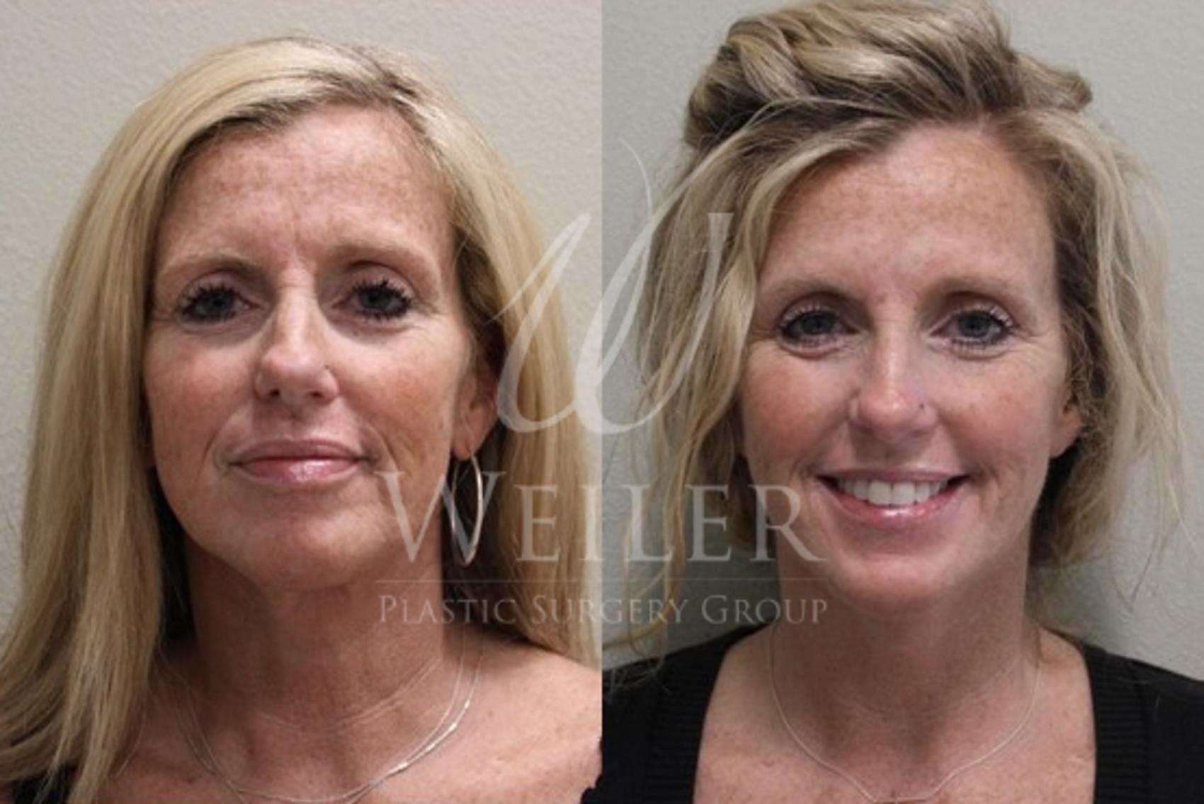Before & After Facelift Case 30 View #1 View in Baton Rouge, New Orleans, & Lafayette, Louisiana