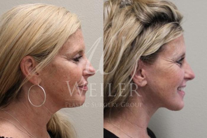 Before & After Facelift Case 30 View #2 View in Baton Rouge, New Orleans, & Lafayette, Louisiana