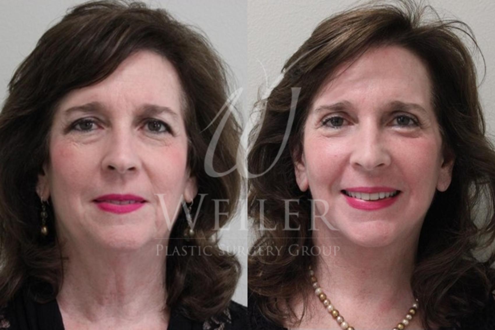Before & After Facelift Case 31 View #1 View in Baton Rouge, Louisiana