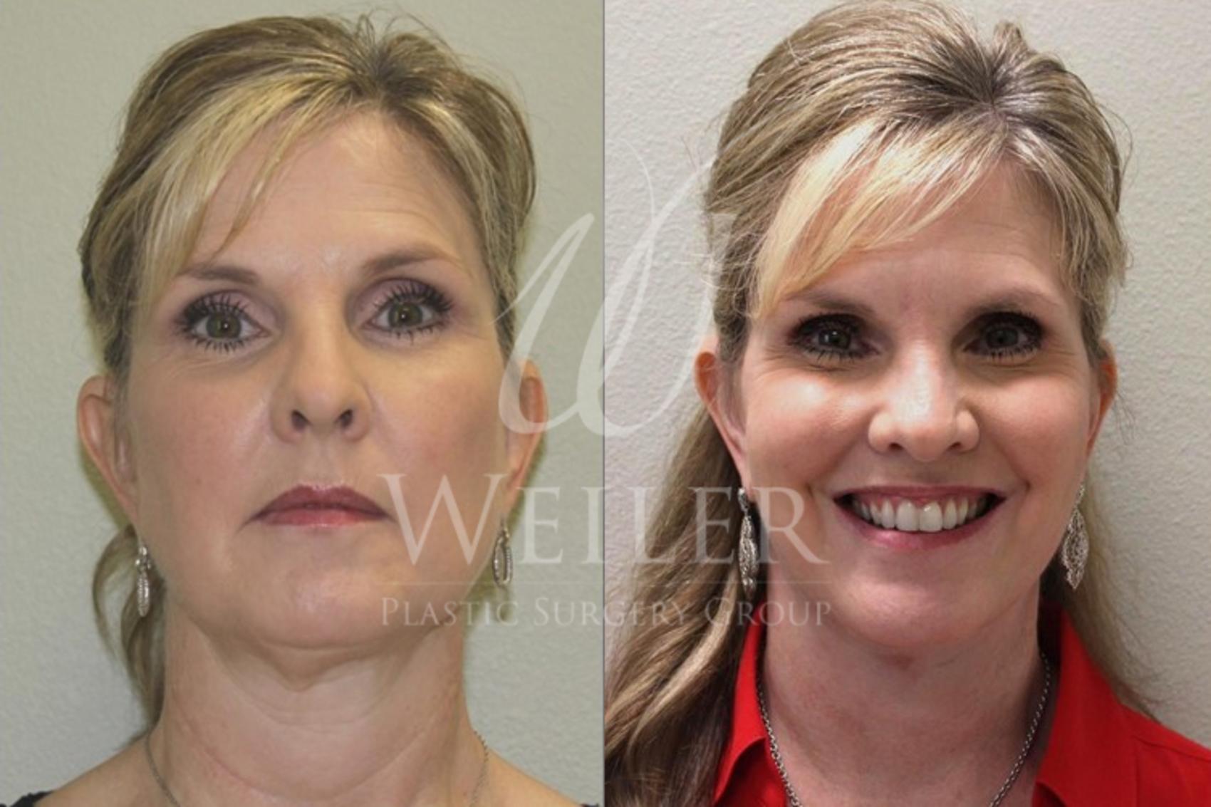 Before & After Facelift Case 32 View #1 View in Baton Rouge, New Orleans, & Lafayette, Louisiana