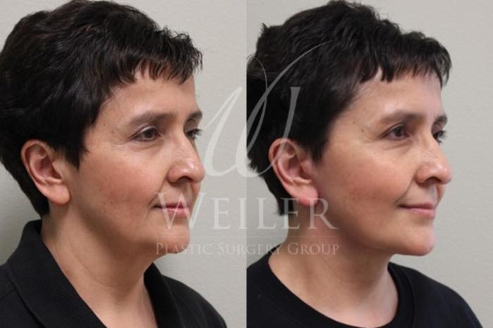 Before & After Facelift Case 33 View #1 View in Baton Rouge, New Orleans, & Lafayette, Louisiana