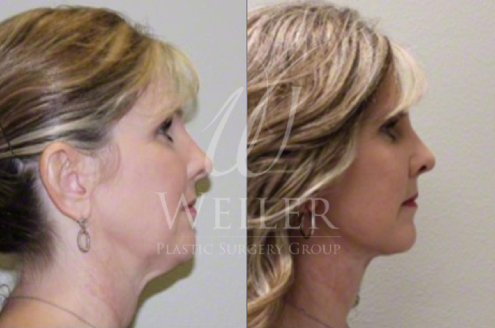 Before & After Facelift Case 34 View #1 View in Baton Rouge, Louisiana