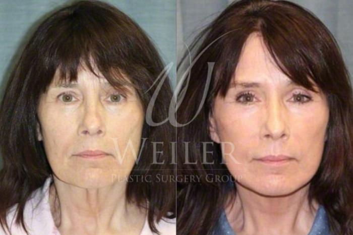 Before & After Facelift Case 35 View #1 View in Baton Rouge, Louisiana