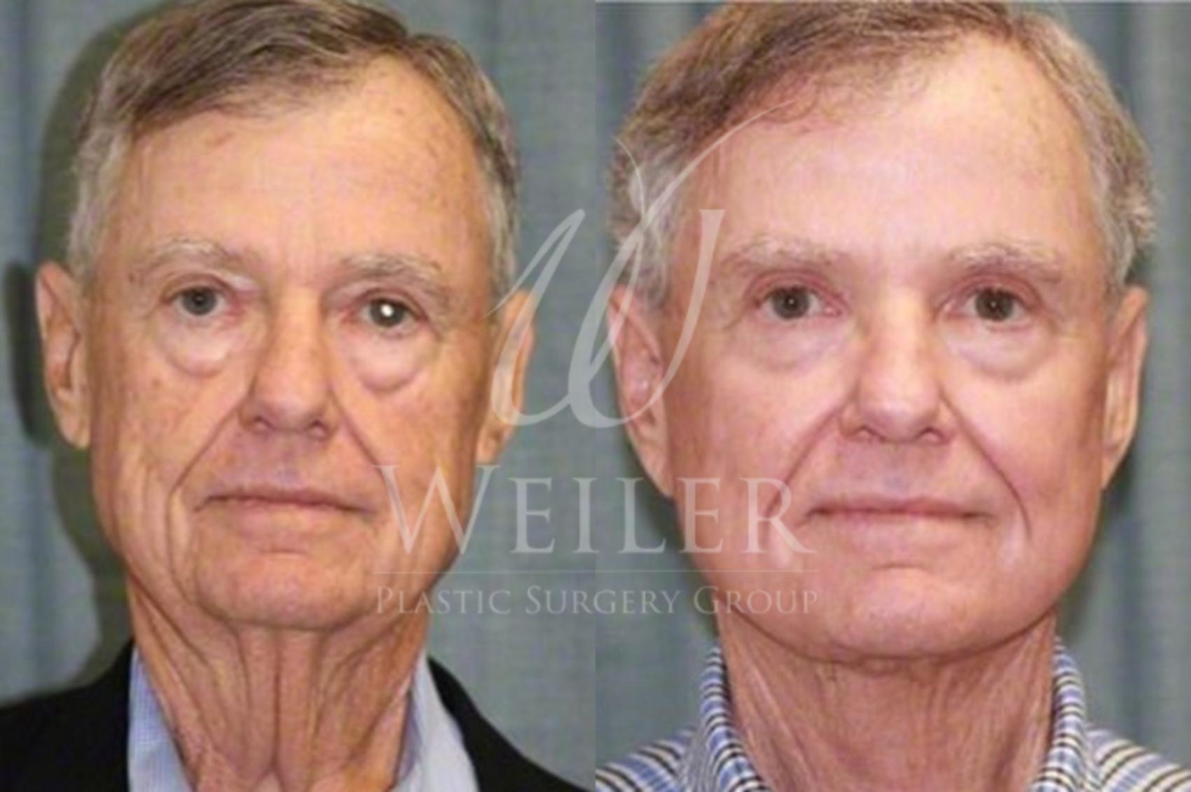 Before & After Facelift Case 36 View #1 View in Baton Rouge, Louisiana