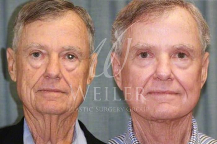Before & After Facelift Case 36 View #1 View in Baton Rouge, New Orleans, & Lafayette, Louisiana