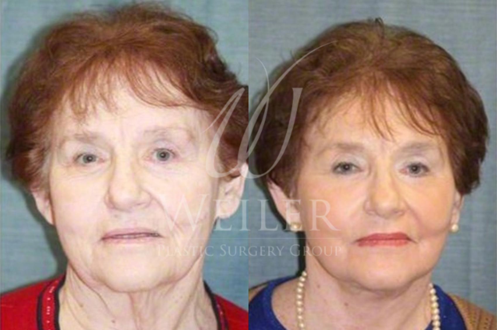 Before & After Facelift Case 37 View #1 View in Baton Rouge, Louisiana