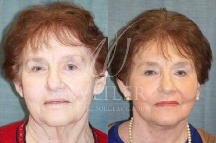 Before & After Facelift Case 37 View #1 View in Baton Rouge, New Orleans, & Lafayette, Louisiana