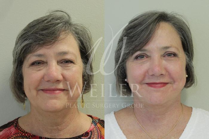 Before & After Facelift Case 427 View #1 View in Baton Rouge, Louisiana