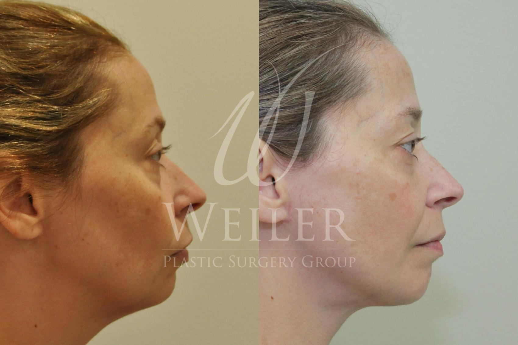 Before & After Facelift Case 435 View #1 View in Baton Rouge, Louisiana