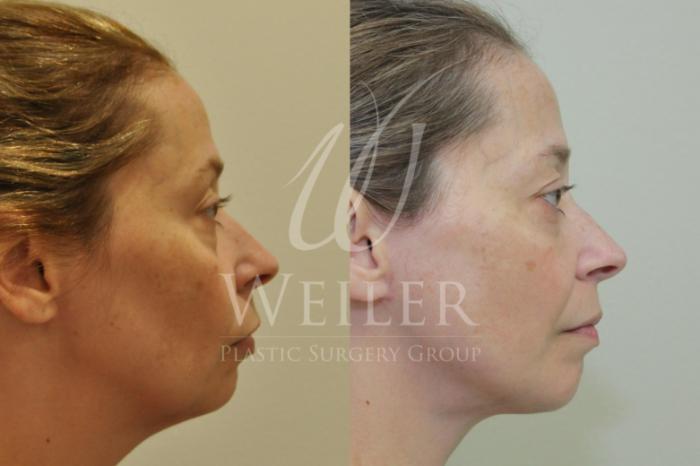 Before & After Facelift Case 435 View #1 View in Baton Rouge, Louisiana