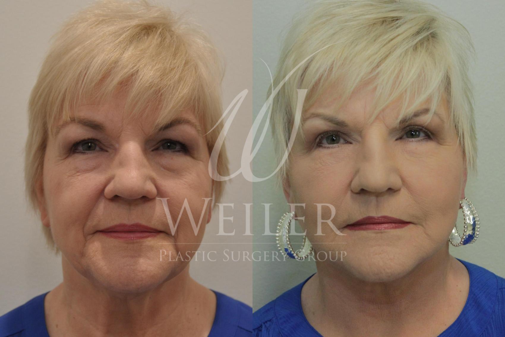 Before & After Facelift Case 442 View #1 View in Baton Rouge, Louisiana