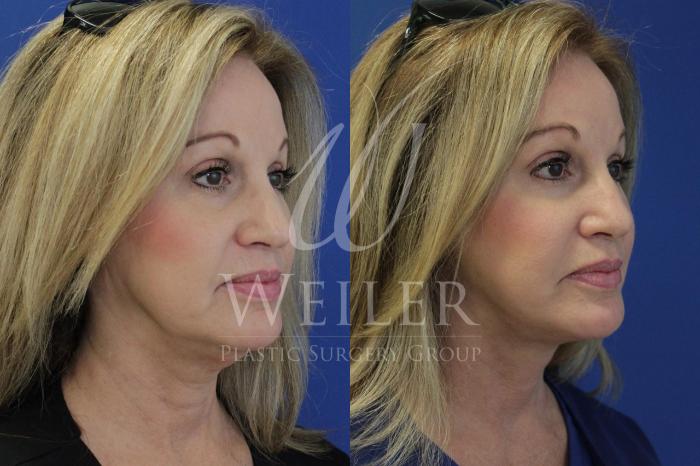 Before & After Facelift Case 452 View #1 View in Baton Rouge, Louisiana