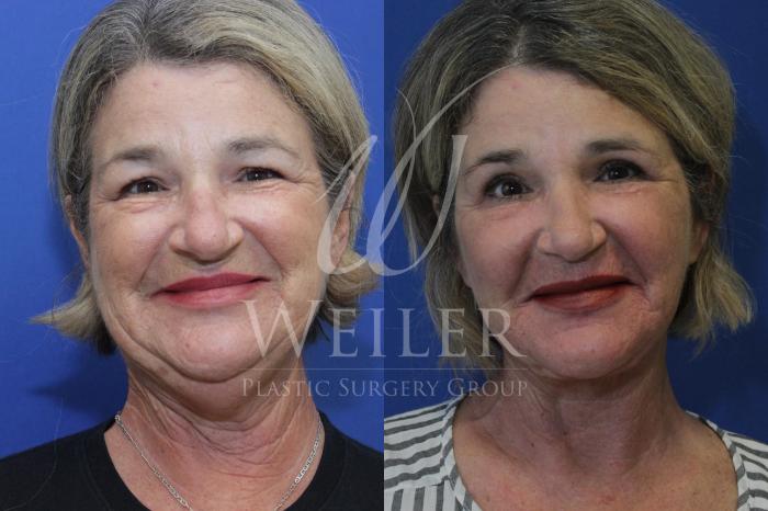 Before & After Facelift Case 497 Front View in Baton Rouge, Louisiana