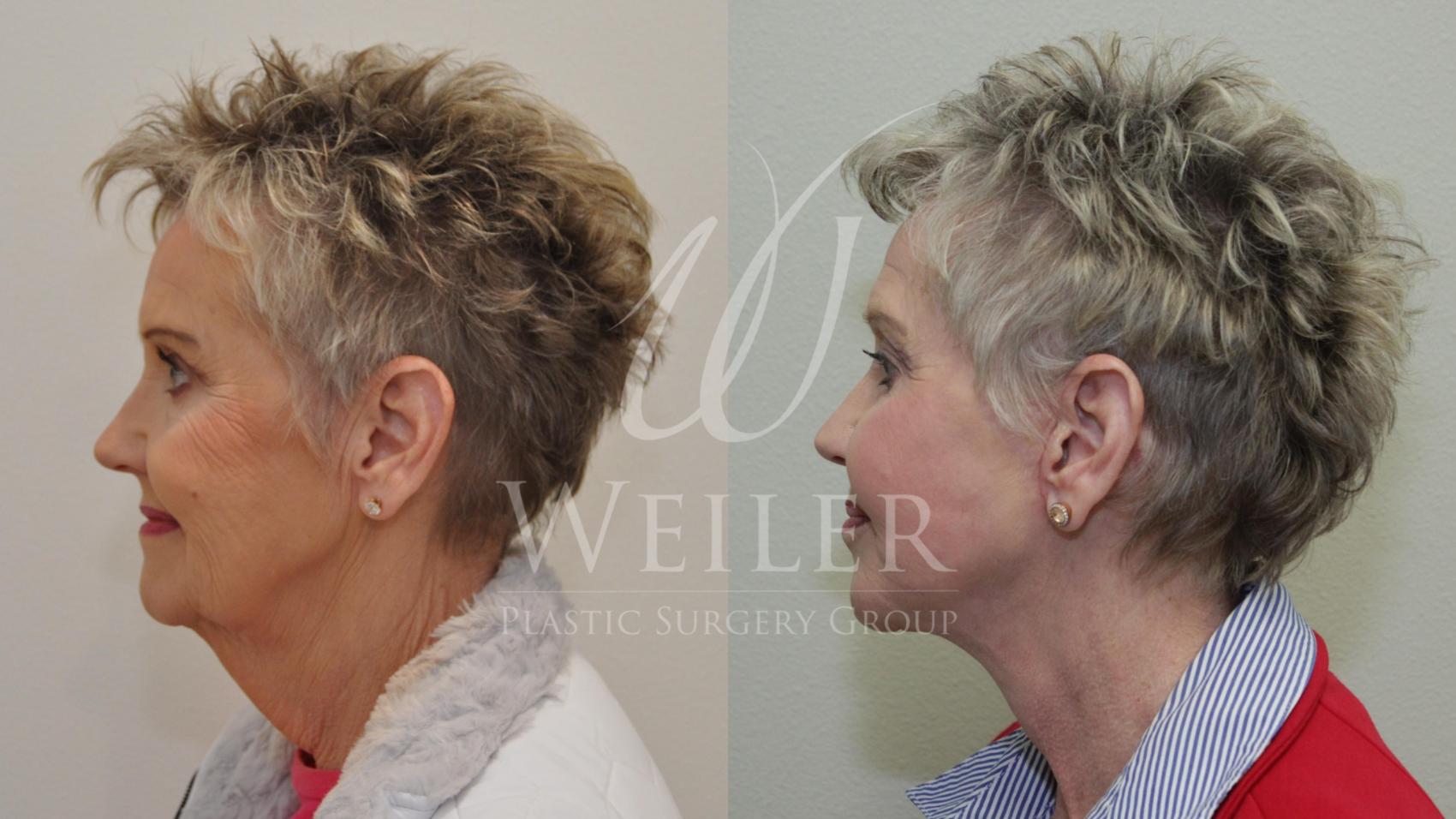 Before & After Facelift Case 564 Left Side View in Baton Rouge, Louisiana