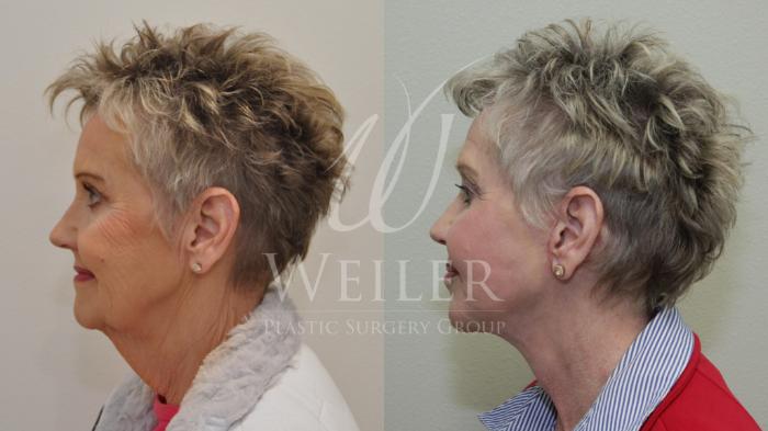 Before & After Facelift Case 564 Left Side View in Baton Rouge, New Orleans, & Lafayette, Louisiana
