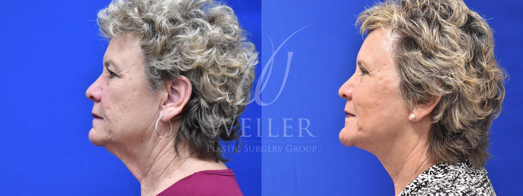 Before & After Facelift Case 595 Left Side View in Baton Rouge, Louisiana
