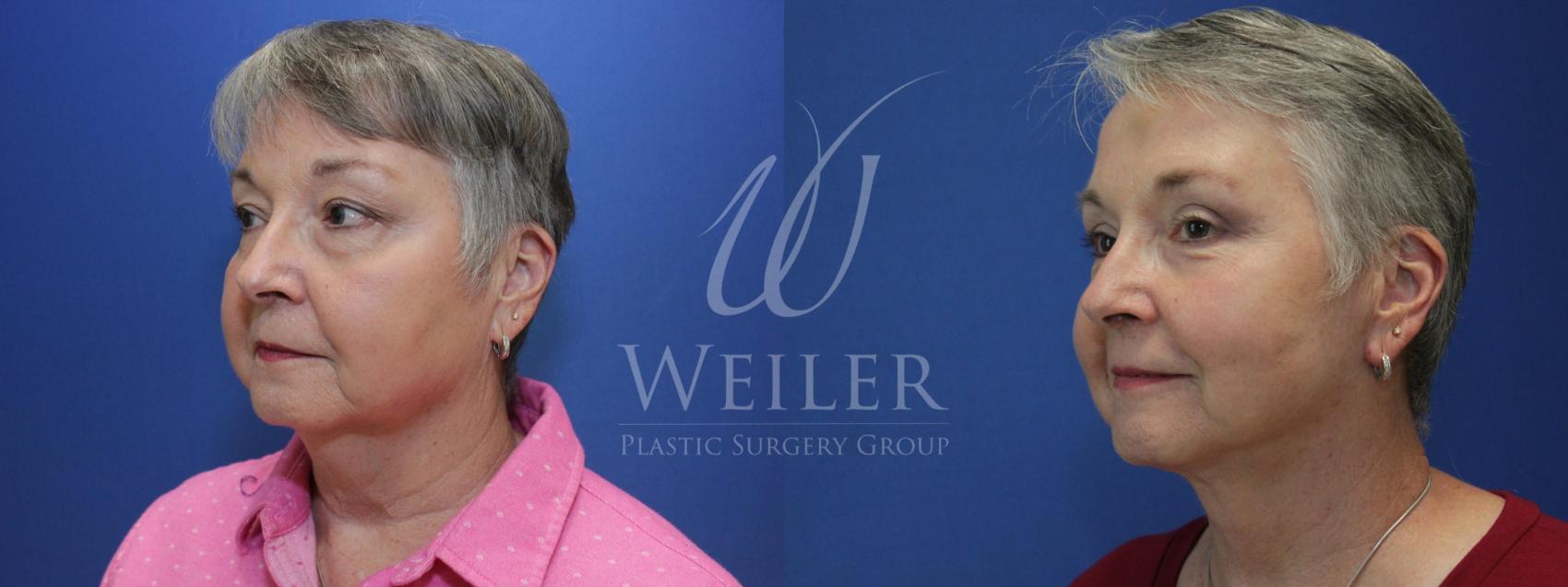 Before & After Facelift Case 596 Left Oblique View in Baton Rouge, Louisiana