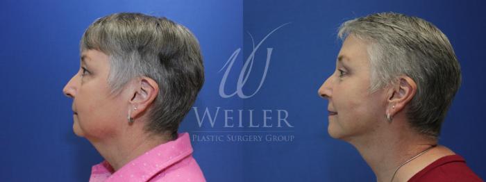 Before & After Facelift Case 596 Left Side View in Baton Rouge, New Orleans, & Lafayette, Louisiana