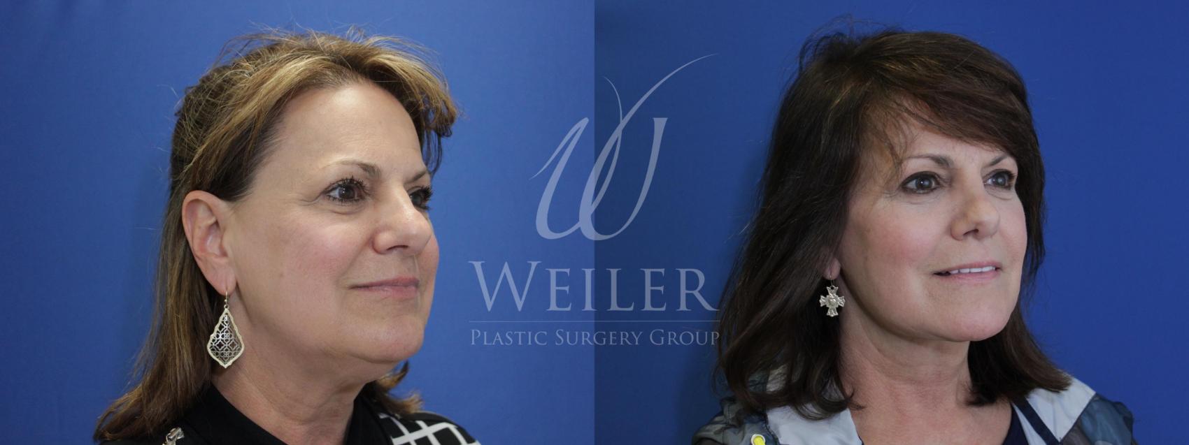 Before & After Facelift Case 723 Right Oblique View in Baton Rouge, Louisiana