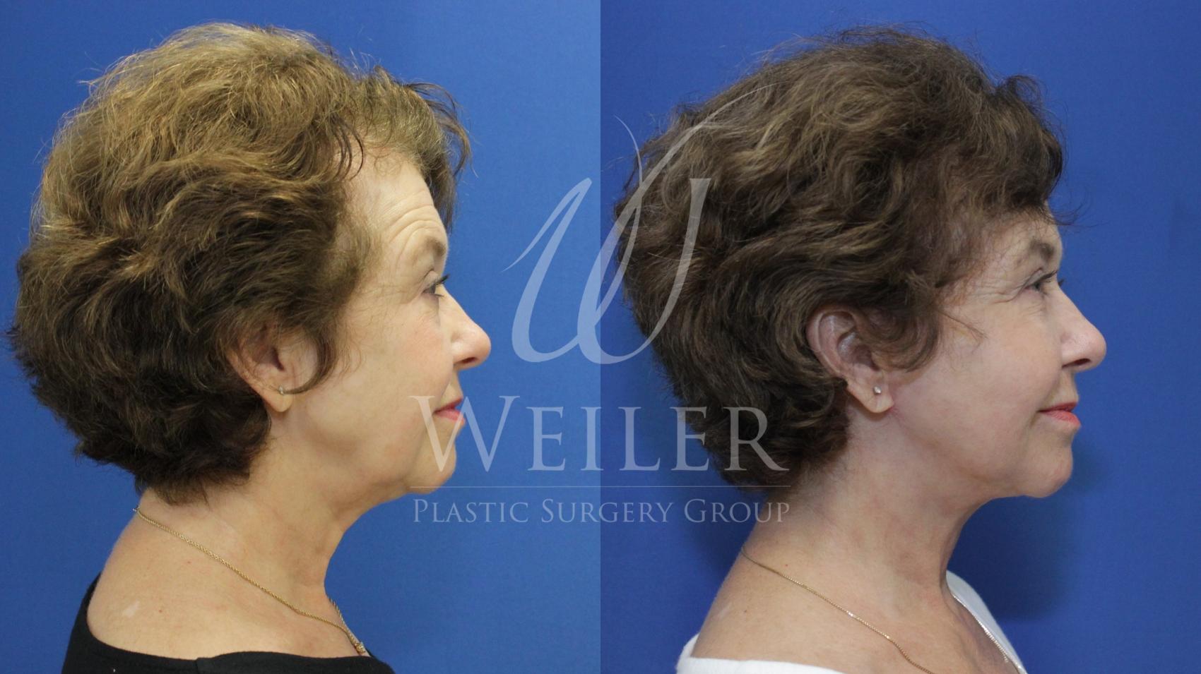 Before & After Facelift Case 742 Right Side View in Baton Rouge, Louisiana