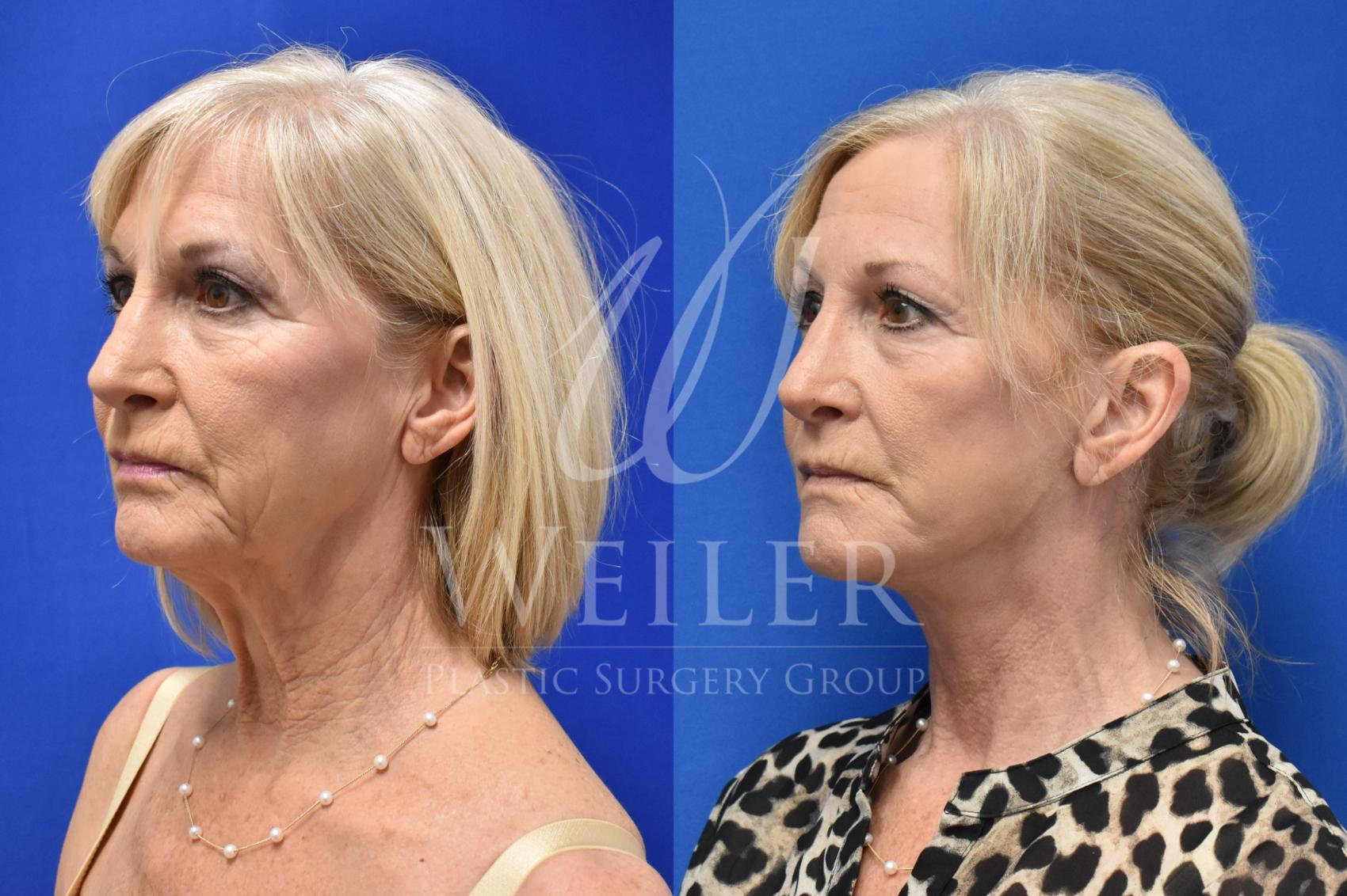 Before & After Facelift Case 762 Left Side View in Baton Rouge, Louisiana