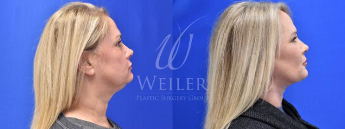 Before & After Facelift Case 772 Right Side View in Baton Rouge, Louisiana