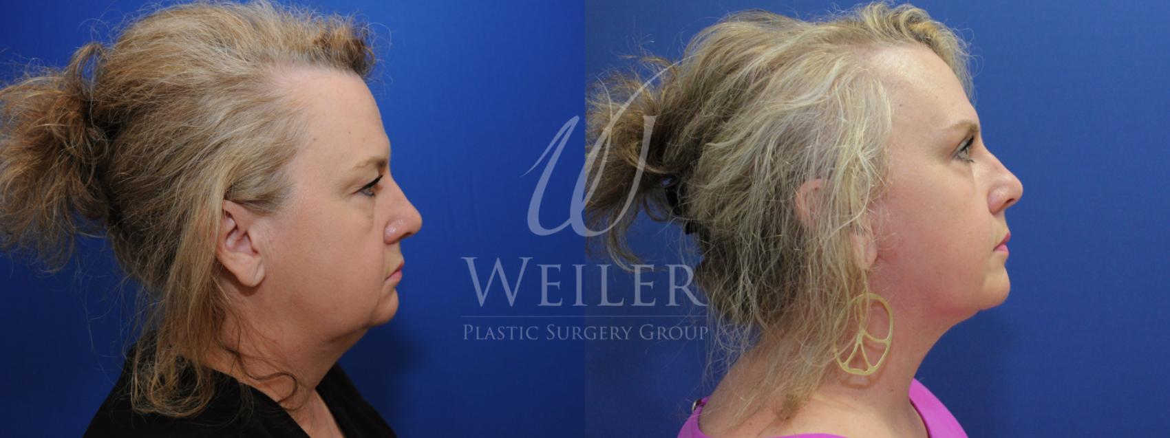Before & After Facelift Case 773 Right Side View in Baton Rouge, Louisiana