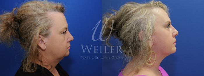 Before & After Facelift Case 773 Right Side View in Baton Rouge, New Orleans, & Lafayette, Louisiana