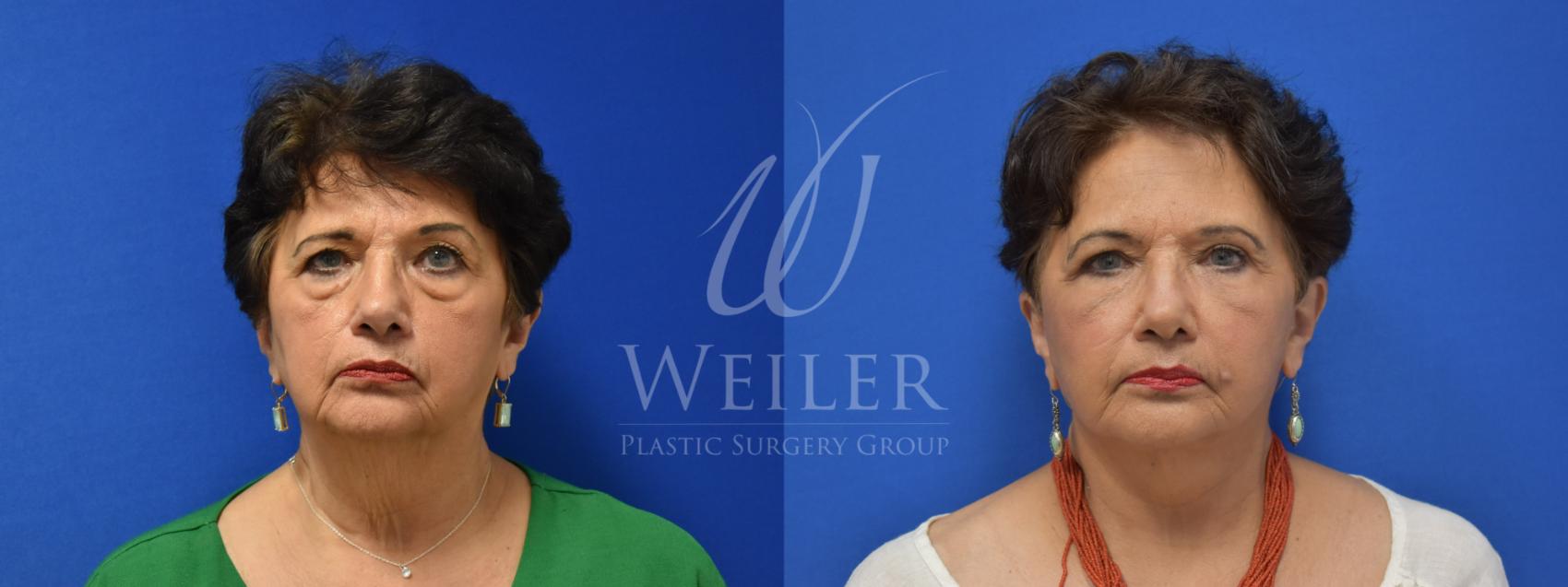 Before & After Facelift Case 774 Front View in Baton Rouge, Louisiana