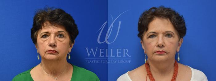 Before & After Facelift Case 774 Front View in Baton Rouge, Louisiana
