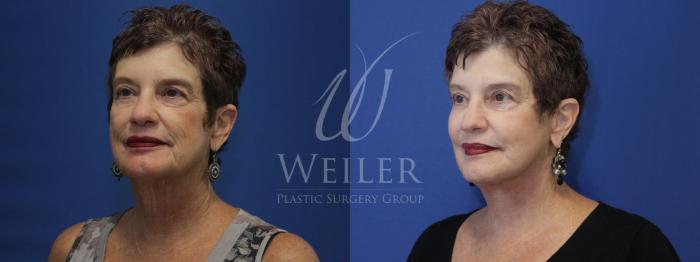 Before & After Facelift Case 776 Left Oblique View in Baton Rouge, Louisiana