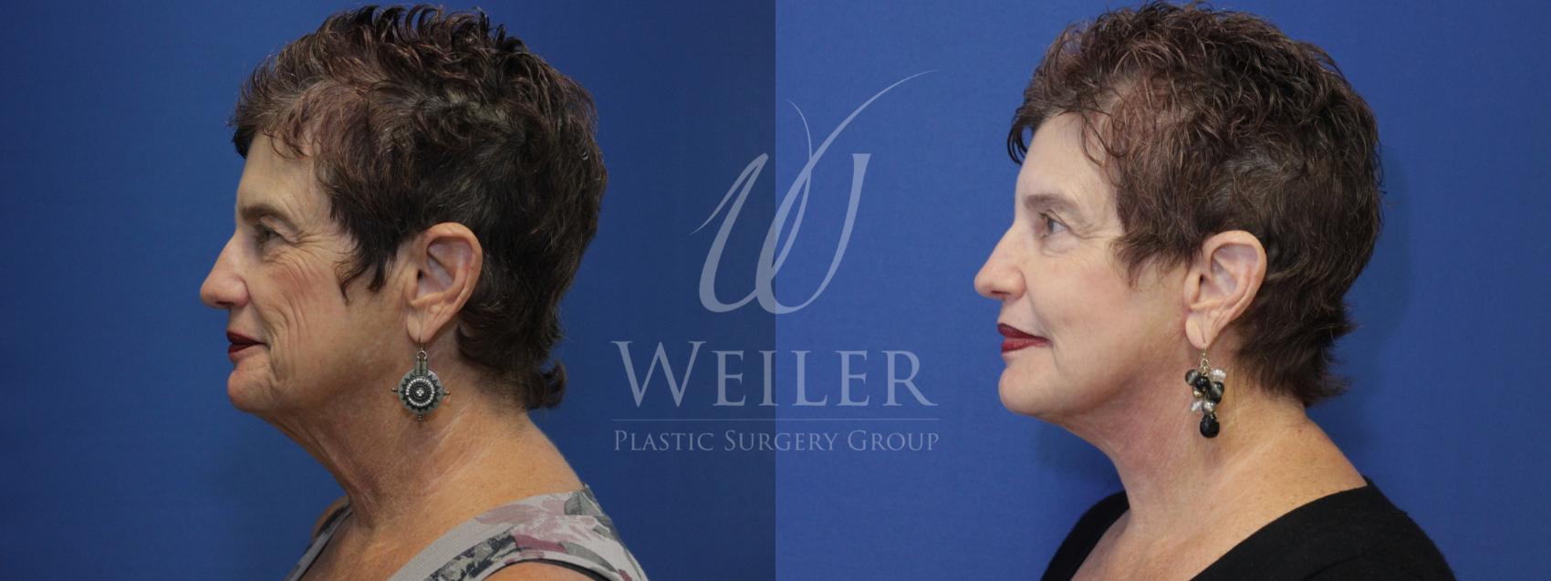 Before & After Facelift Case 776 Left Side View in Baton Rouge, Louisiana