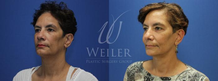 Before & After Facelift Case 778 Left Oblique View in Baton Rouge, New Orleans, & Lafayette, Louisiana