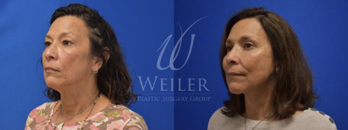 Before & After Facelift Case 786 Left Oblique View in Baton Rouge, New Orleans, & Lafayette, Louisiana