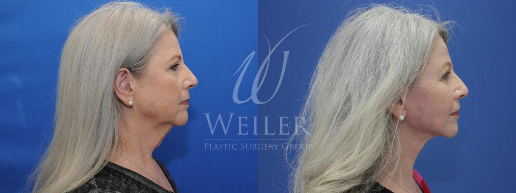 Before & After Facelift Case 811 Right Side View in Baton Rouge, Louisiana